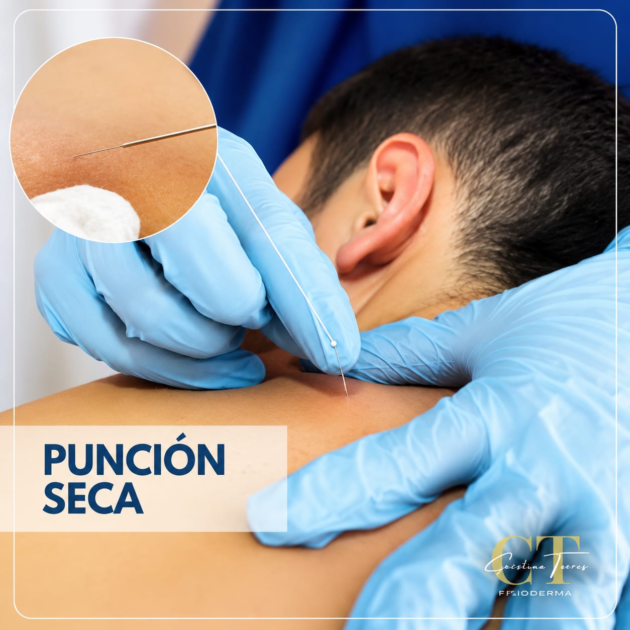 Acupuntura