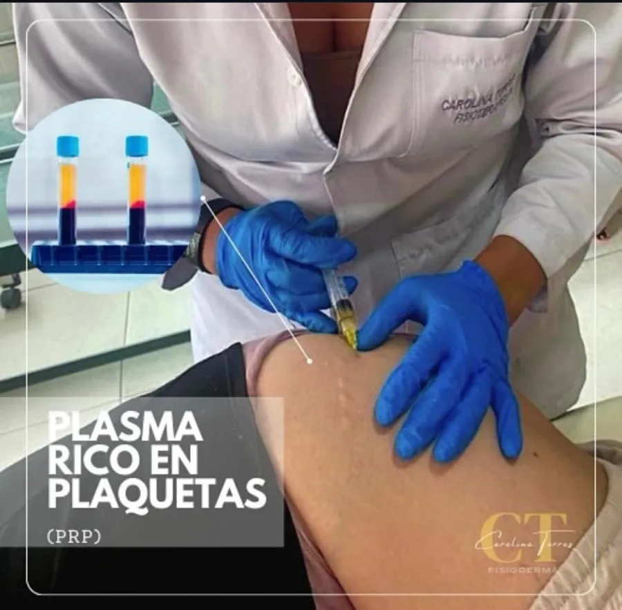 Plasma rico en plaquetas